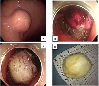 Case report: A large gastric calcifying fibrous tumor treated with endoscopic submucosal excavation